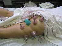 Professional Cupping Therapies